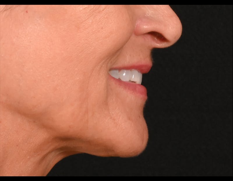 Lip Lift Before & After Gallery - Patient 301052 - Image 5