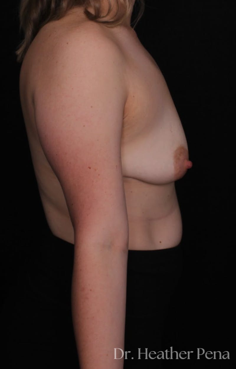 Breast Augmentation with Lift Before & After Gallery - Patient 246781 - Image 3
