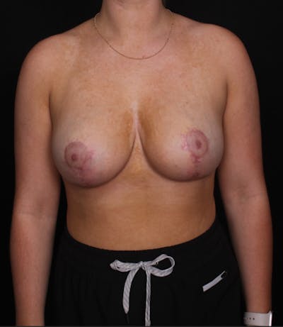 Breast Reduction Before & After Gallery - Patient 967912 - Image 2