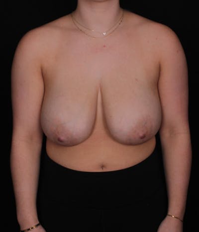 Breast Reduction Before & After Gallery - Patient 967912 - Image 1