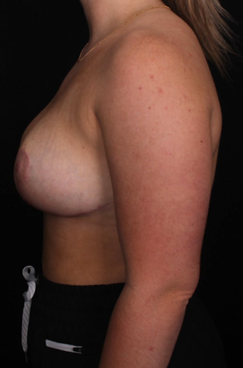 Breast Reduction Before & After Gallery - Patient 967912 - Image 3
