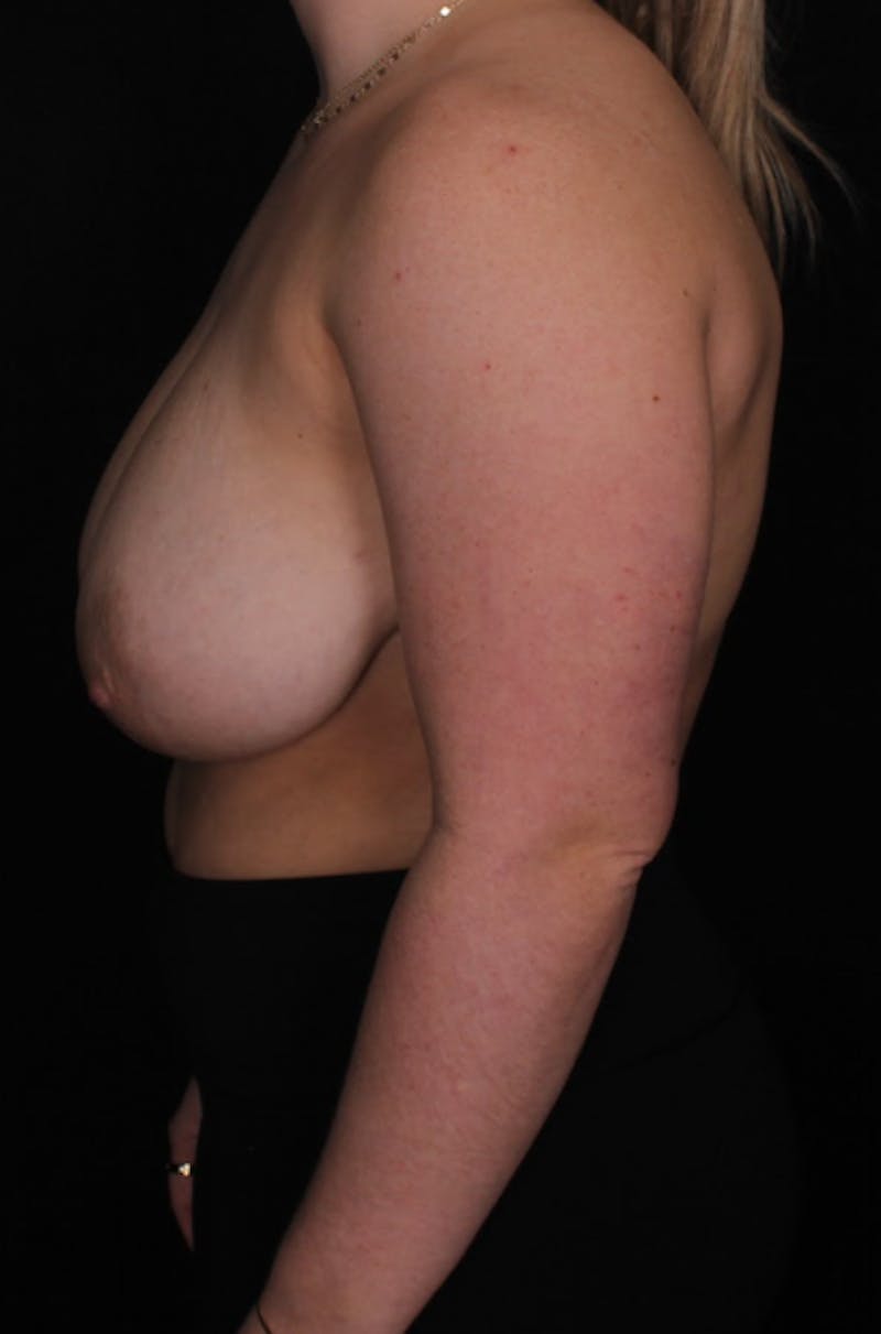 Breast Reduction Before & After Gallery - Patient 967912 - Image 4