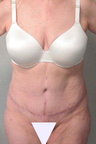 Abdominoplasty Before & After Gallery - Patient 311498 - Image 2