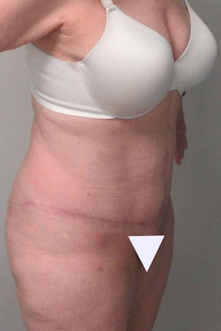 Abdominoplasty Before & After Gallery - Patient 311498 - Image 4