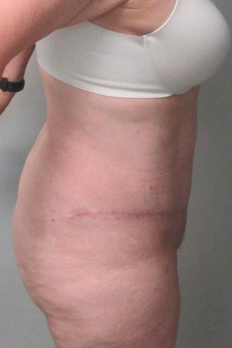 Abdominoplasty Before & After Gallery - Patient 311498 - Image 6