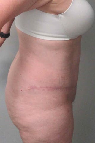 Abdominoplasty Before & After Gallery - Patient 311498 - Image 6