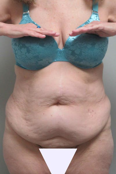 Abdominoplasty Before & After Gallery - Patient 311498 - Image 1