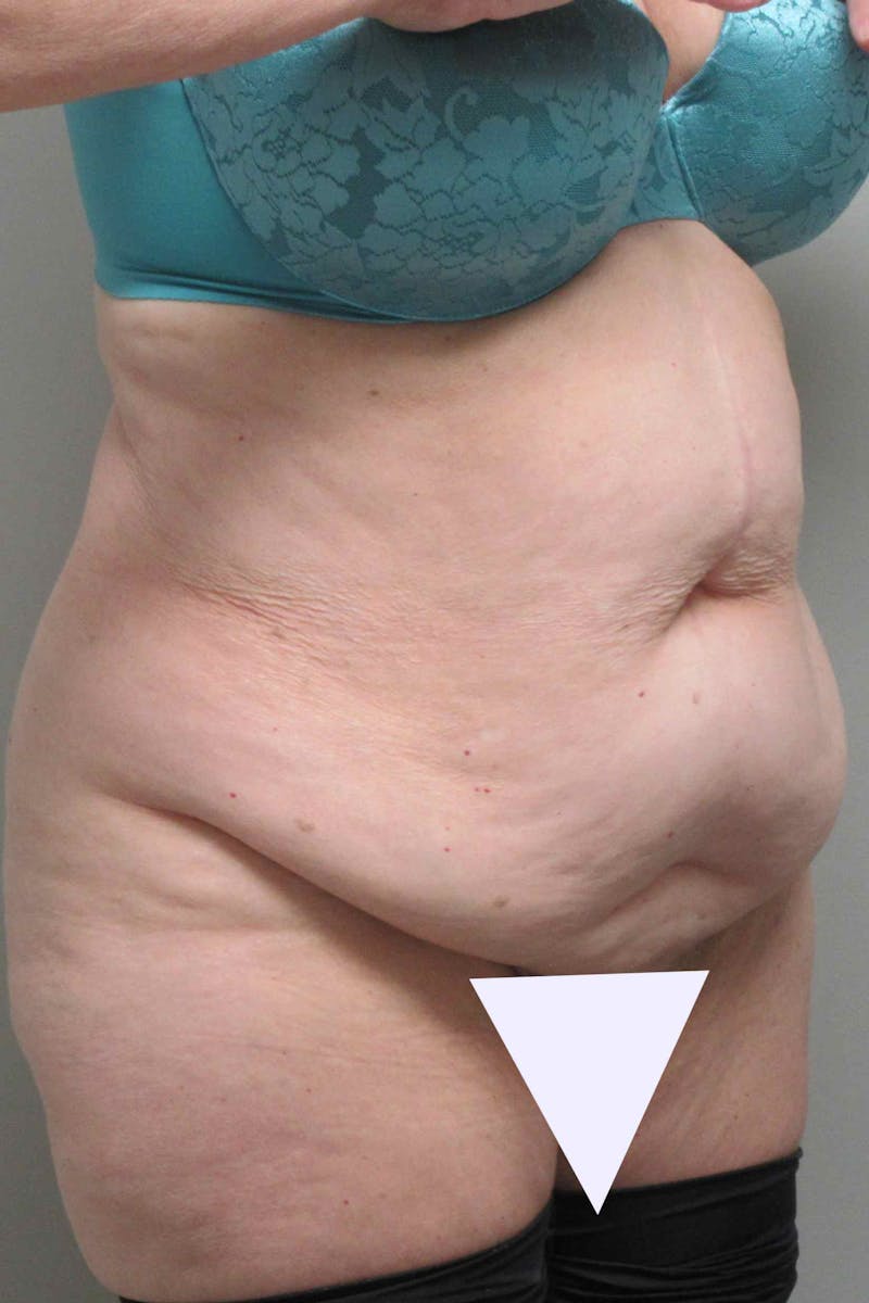Abdominoplasty Before & After Gallery - Patient 311498 - Image 3