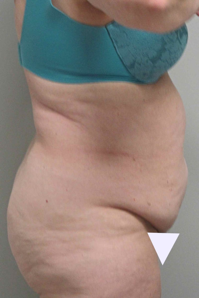 Abdominoplasty Before & After Gallery - Patient 311498 - Image 5
