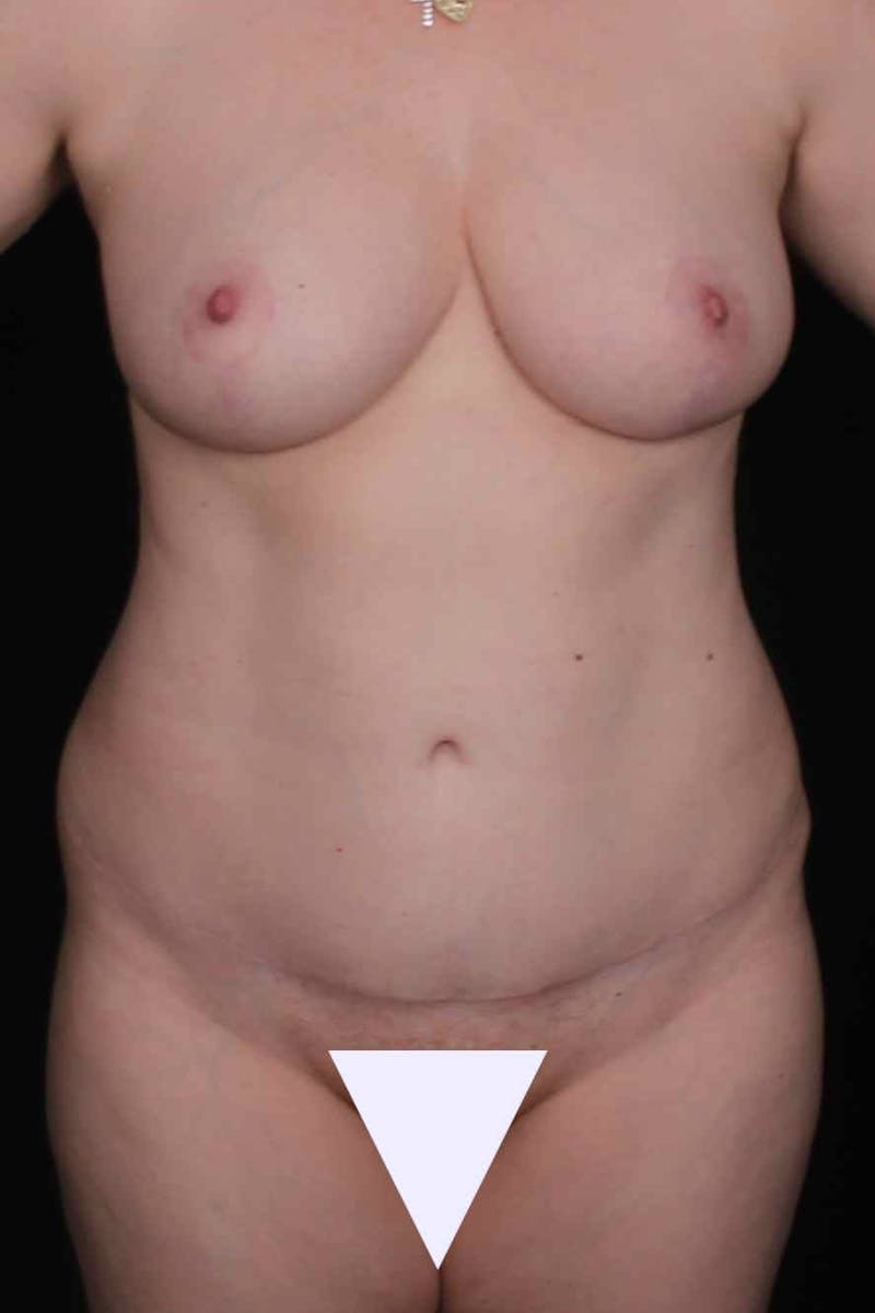Abdominoplasty Before & After Gallery - Patient 445721 - Image 2