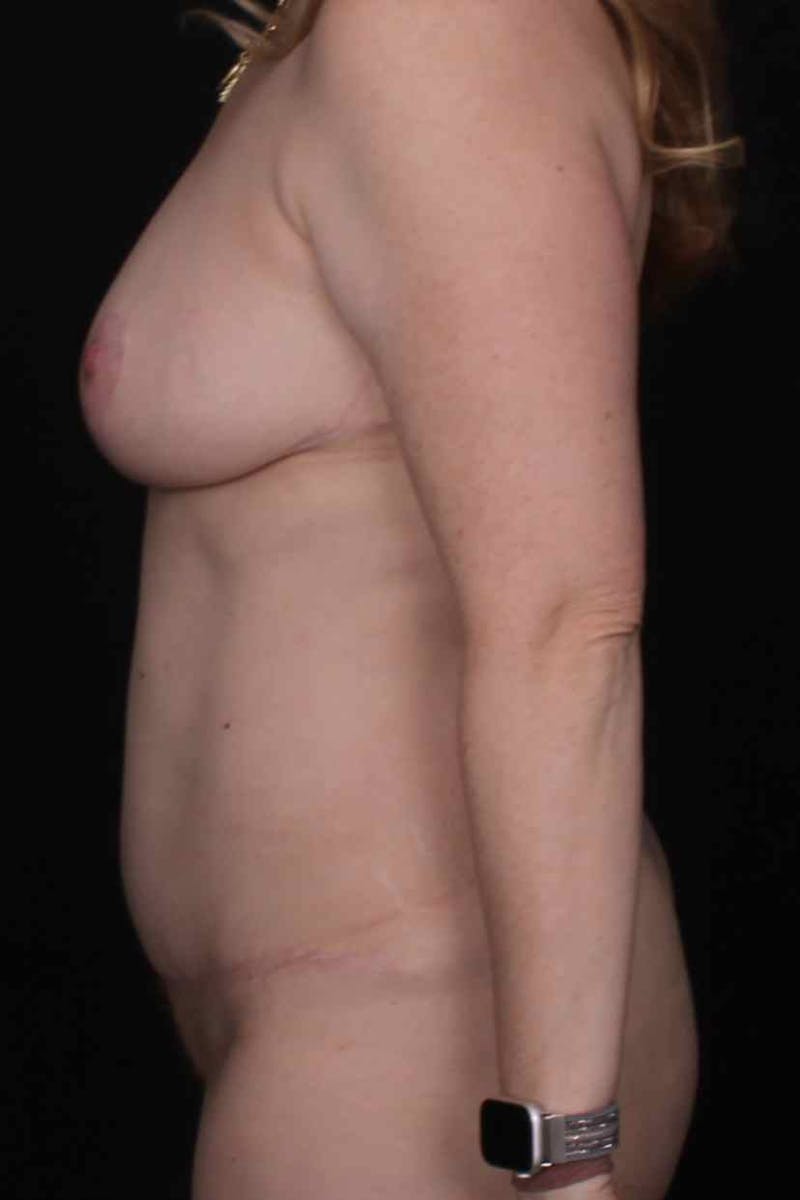 Abdominoplasty Before & After Gallery - Patient 445721 - Image 6