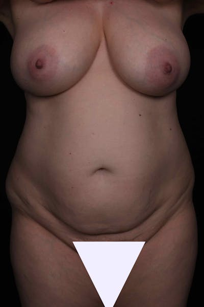 Abdominoplasty Before & After Gallery - Patient 445721 - Image 1