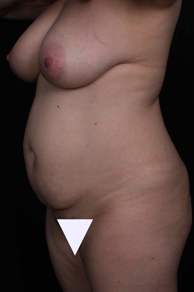 Abdominoplasty Before & After Gallery - Patient 445721 - Image 3