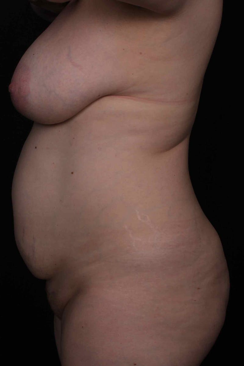 Abdominoplasty Before & After Gallery - Patient 445721 - Image 5
