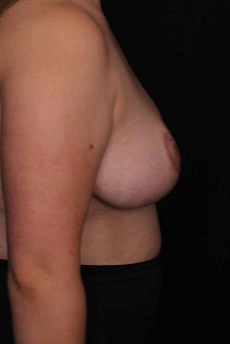 Breast Reduction Before & After Gallery - Patient 277760 - Image 5