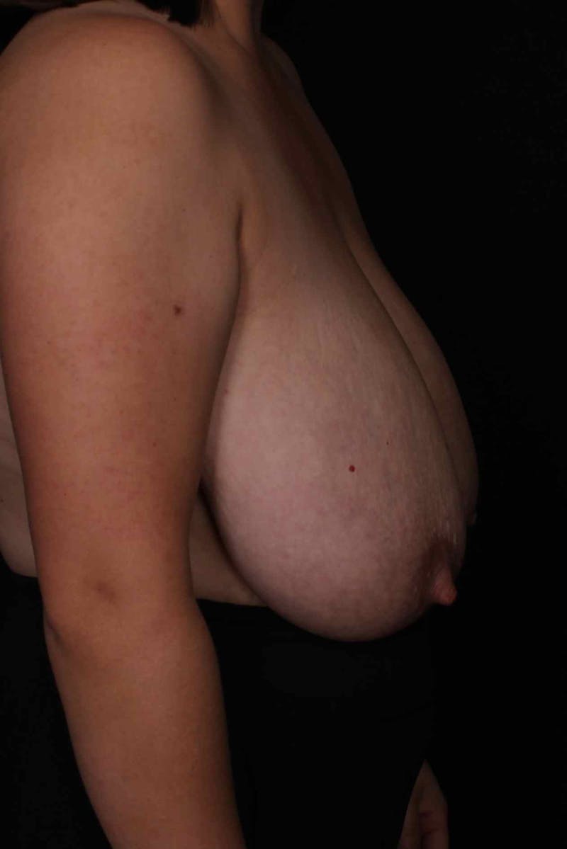 Breast Reduction Before & After Gallery - Patient 277760 - Image 6