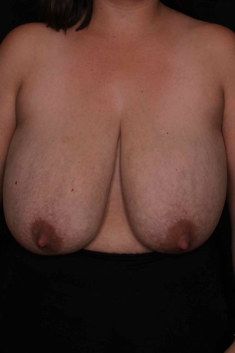 Breast Reduction Before & After Gallery - Patient 277760 - Image 1