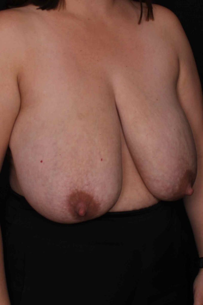 Breast Reduction Before & After Gallery - Patient 277760 - Image 3