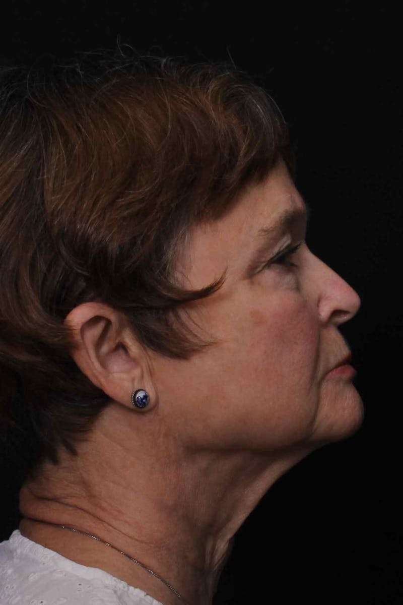 Facelift with Bleph Before & After Gallery - Patient 274954 - Image 3