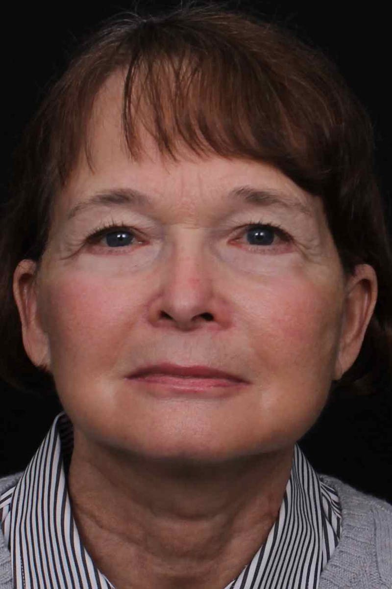 Facelift with Bleph Before & After Gallery - Patient 274954 - Image 2