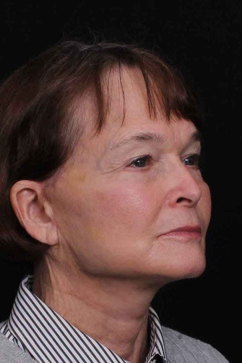 Facelift with Bleph Before & After Gallery - Patient 274954 - Image 6