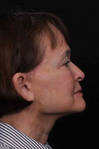 Facelift with Bleph Before & After Gallery - Patient 274954 - Image 4