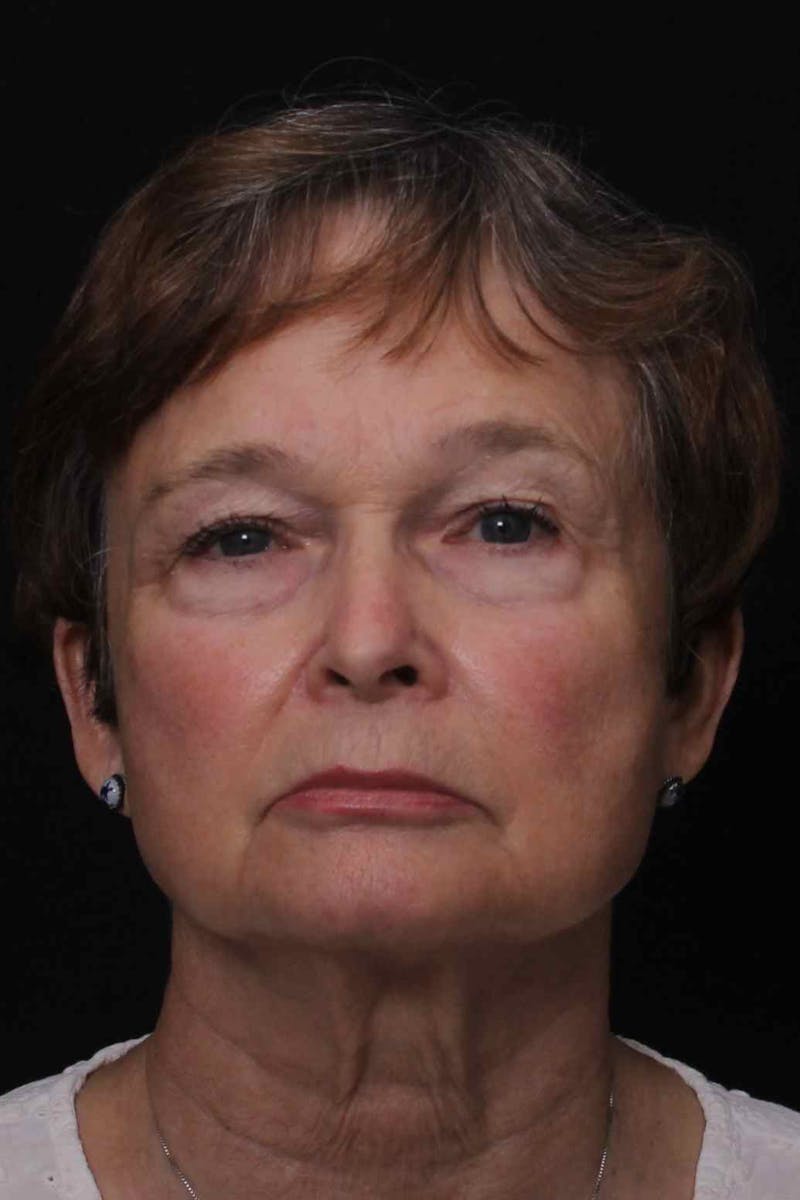 Facelift with Bleph Before & After Gallery - Patient 274954 - Image 1