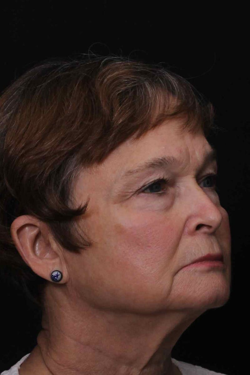 Facelift with Bleph Before & After Gallery - Patient 274954 - Image 5