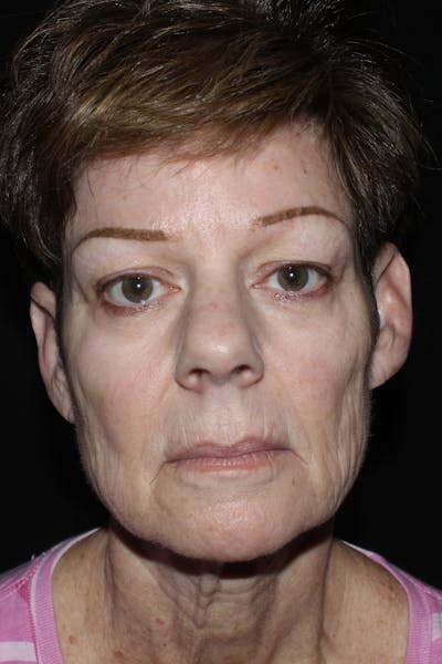 Facelift with Bleph Before & After Gallery - Patient 320281 - Image 1