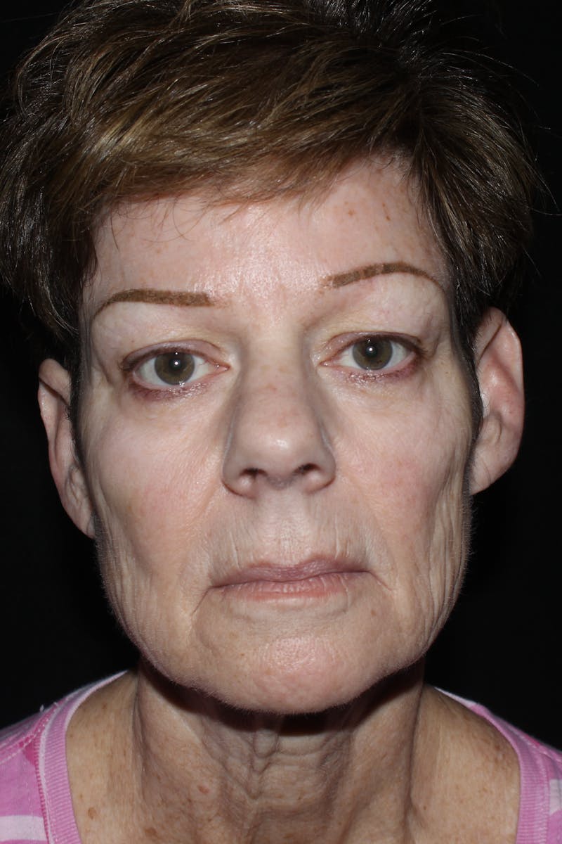 Facelift with Bleph Before & After Gallery - Patient 320281 - Image 1
