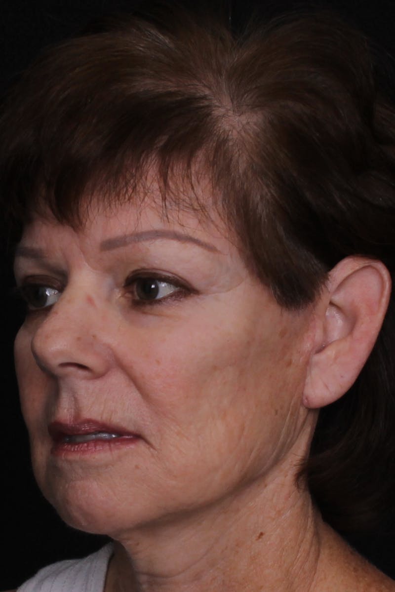Facelift with Bleph Before & After Gallery - Patient 320281 - Image 4
