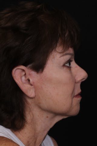 Facelift with Bleph Before & After Gallery - Patient 320281 - Image 6
