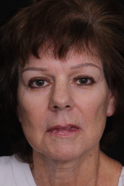 Facelift with Bleph Before & After Gallery - Patient 320281 - Image 2