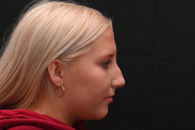 Rhinoplasty Before & After Gallery - Patient 652045 - Image 1