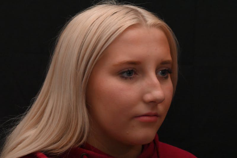 Rhinoplasty Before & After Gallery - Patient 652045 - Image 7