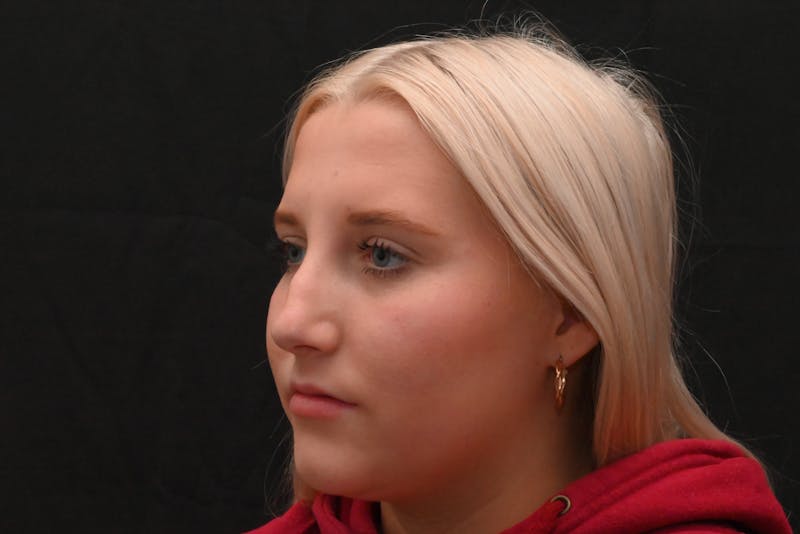 Rhinoplasty Before & After Gallery - Patient 652045 - Image 9