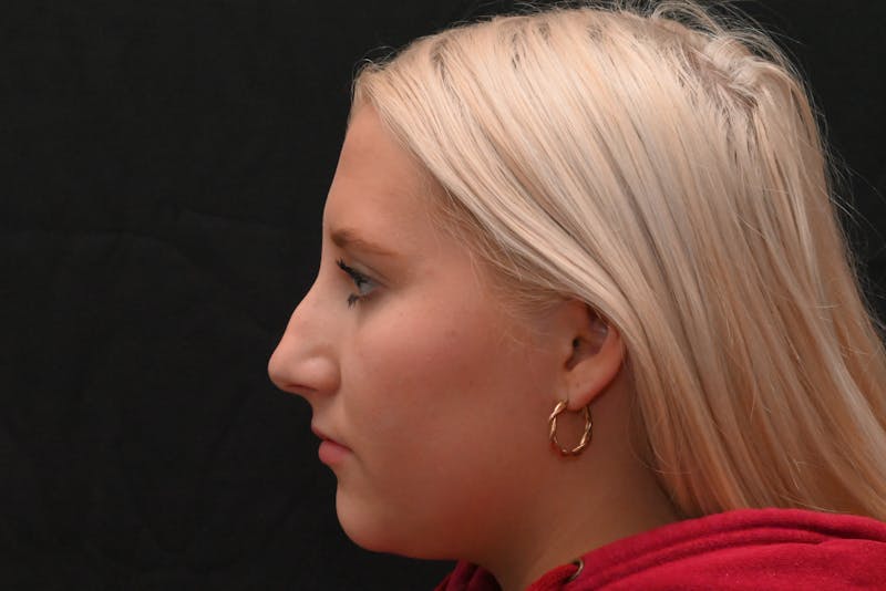 Rhinoplasty Before & After Gallery - Patient 652045 - Image 11