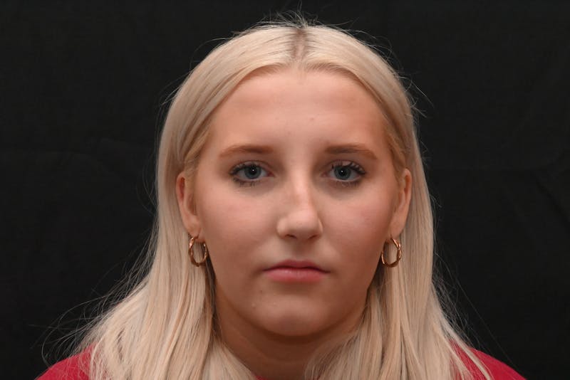 Rhinoplasty Before & After Gallery - Patient 652045 - Image 13