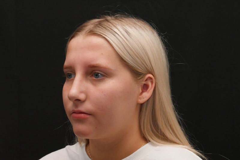 Rhinoplasty Before & After Gallery - Patient 652045 - Image 10