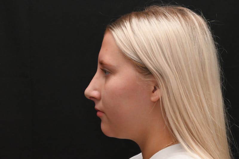 Rhinoplasty Before & After Gallery - Patient 652045 - Image 12