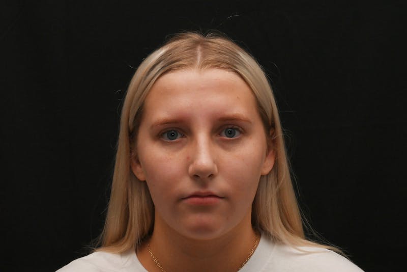 Rhinoplasty Before & After Gallery - Patient 652045 - Image 14