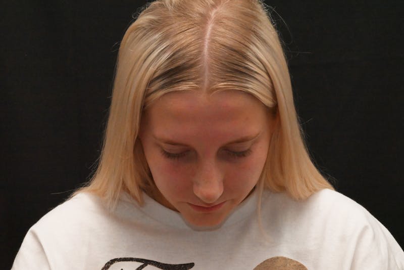 Rhinoplasty Before & After Gallery - Patient 652045 - Image 4