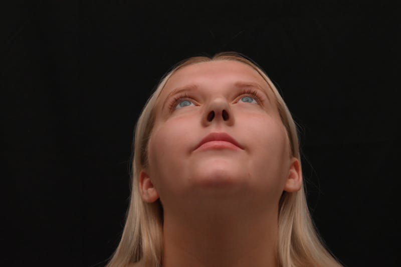 Rhinoplasty Before & After Gallery - Patient 652045 - Image 6