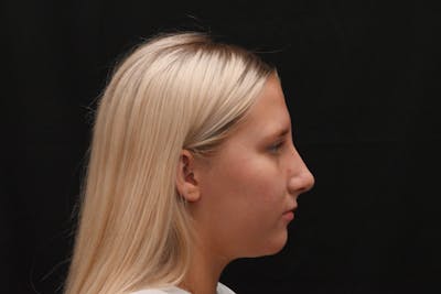 Rhinoplasty Before & After Gallery - Patient 652045 - Image 2