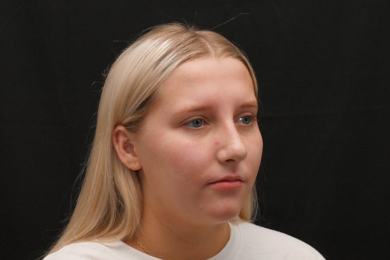 Rhinoplasty Before & After Gallery - Patient 652045 - Image 8
