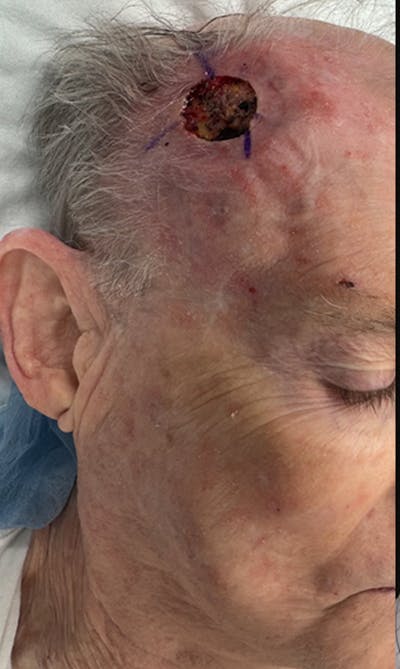 Mohs Facial Reconstruction  Before & After Gallery - Patient 371369 - Image 1
