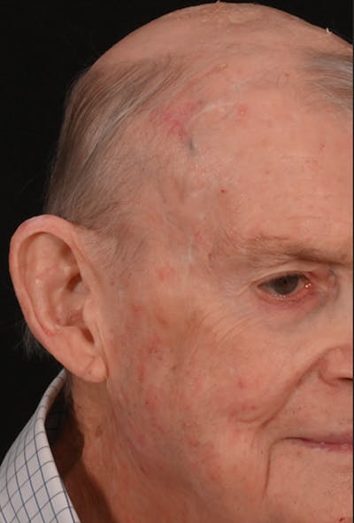 Mohs Facial Reconstruction  Before & After Gallery - Patient 371369 - Image 2