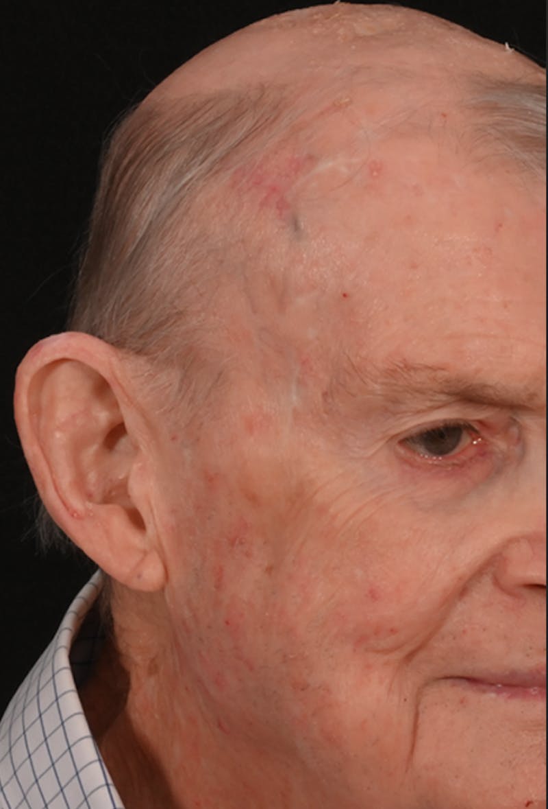 Mohs Facial Reconstruction  Before & After Gallery - Patient 371369 - Image 2