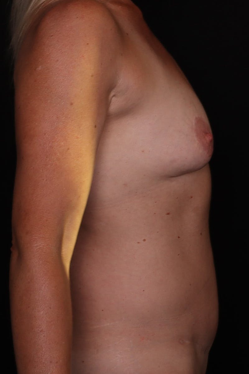 Abdominoplasty Before & After Gallery - Patient 244886 - Image 6