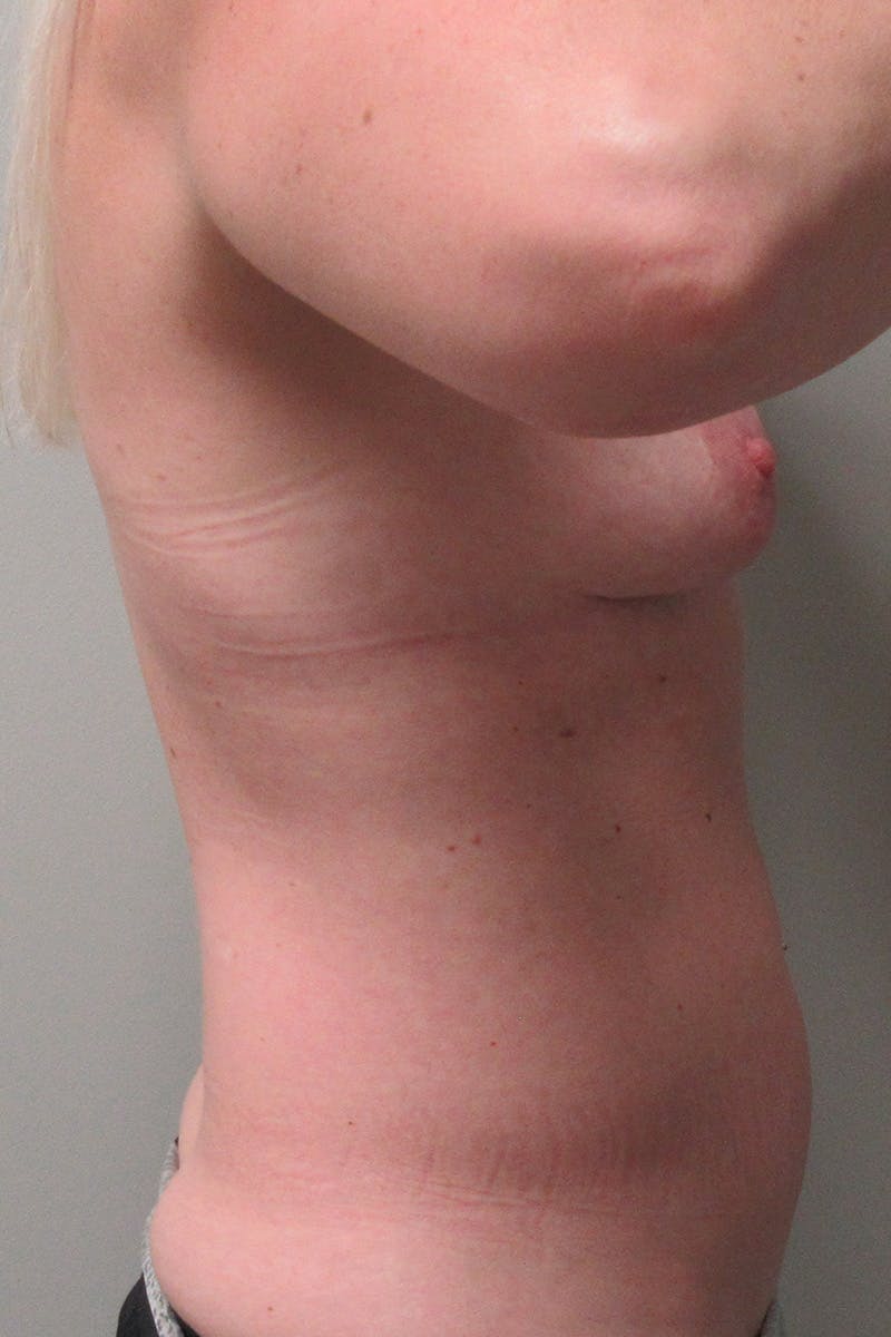 Abdominoplasty Before & After Gallery - Patient 244886 - Image 5